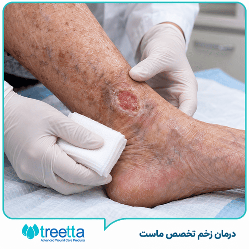 زخم مزمن چیست| انواع، علائم و پیشگیری، درمان
