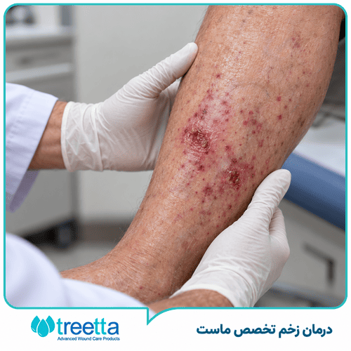 زخم واسکولیتی چیست ؟ دلایل ایجاد زخم واسکولیتی