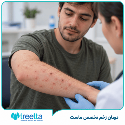 درمان آبله مرغان مرغون