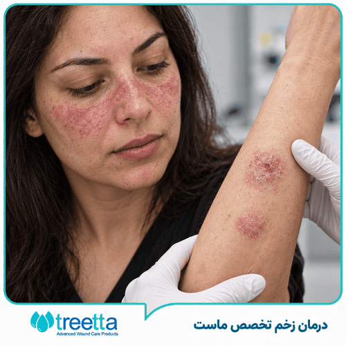 تشخیص، درمان و زخم بیماری لوپوس