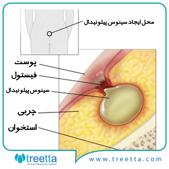 درمان کیست-مویی-با-تریتا