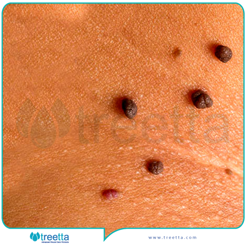 درمان خال گوشتی