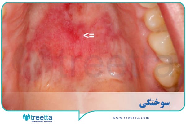 تشخیص سوختگی سقف دهان