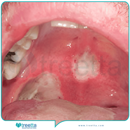 درمان سوختگی دهان