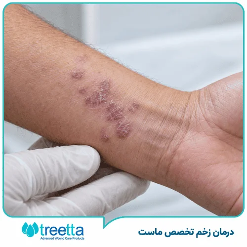 لیکن پلان چیست؟ تشخیص، علائم و روش های درمان