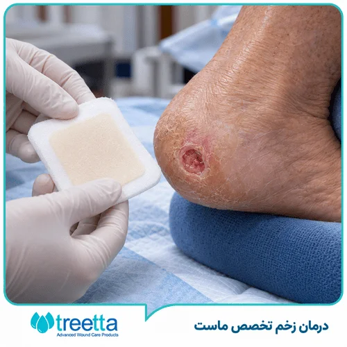 درمان زخم بستر حفره ای