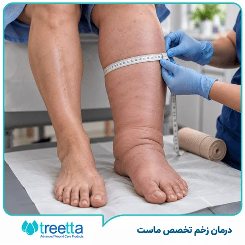 لنف ادم چیست؟