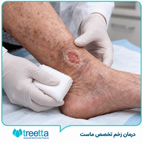 زخم مزمن چیست| انواع، علائم و پیشگیری، درمان