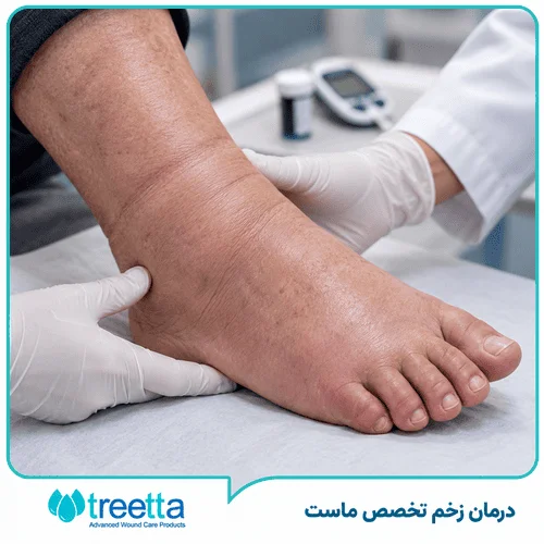 تشخیص و درمان ورم پا ناشی از دیابت