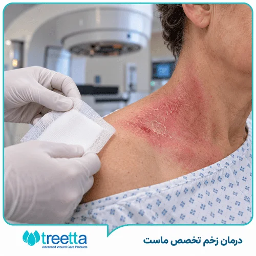 تشخیص و درمان زخم رادیو تراپی