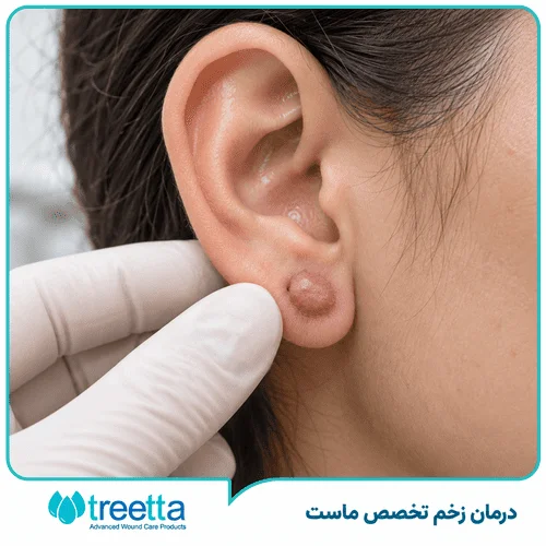 تشخیص و درمان کلوئید گوش