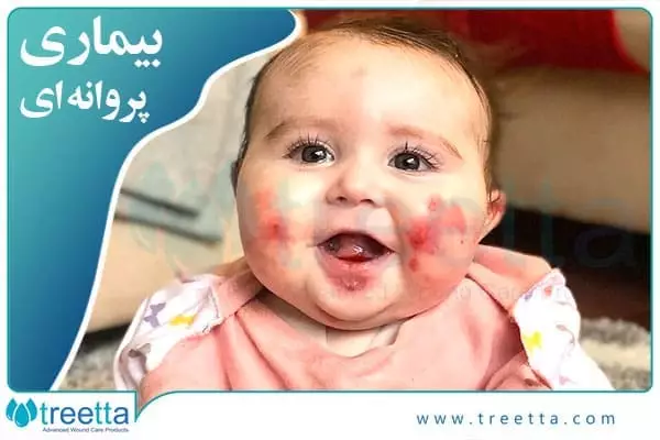 استفاده از لباس‌های نرم در بیماری ای بی