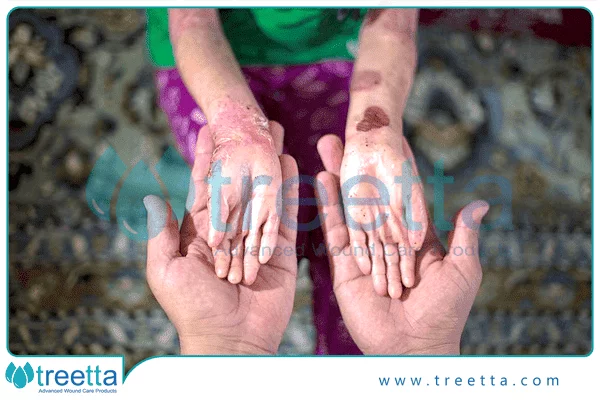 بیماری eb و ارتباط آن با فاکتورهای محیطی