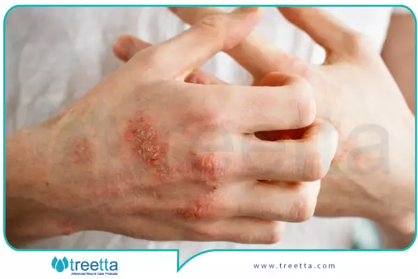 تأثیر دیابت روی پوست