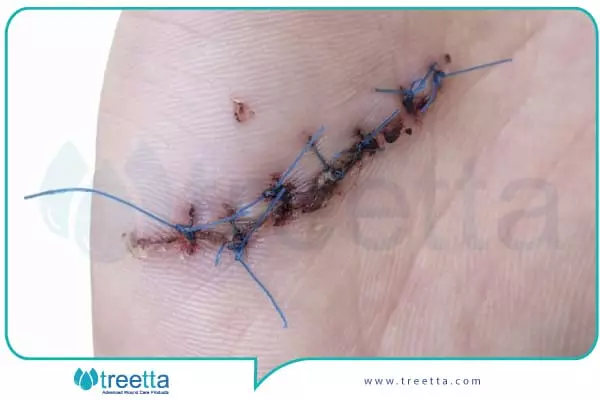 در چه مواقعی باید بخیه زخم را انجام داد؟