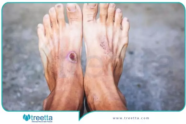 علائم و تشخیص کتواسیدوز