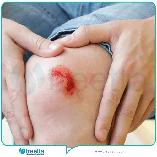پیشگیری از آسیب های زخم تروماتیک