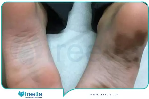 پیشگیری از سیاه شدن پا در اثر دیابت