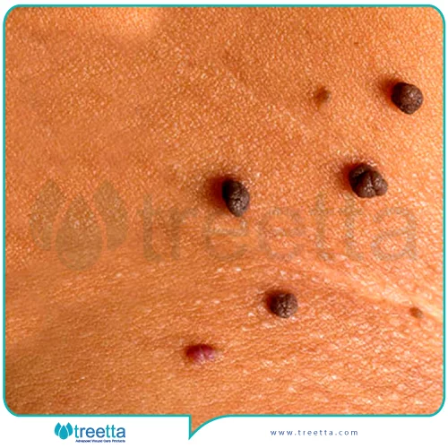 درمان خال گوشتی