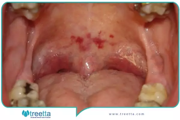 سوختگی دهان کودک