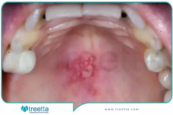 سوختگی دهان